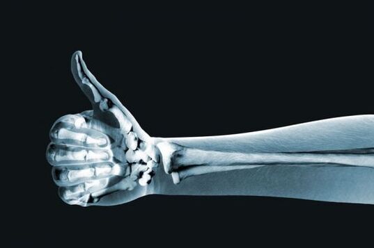 Röntgenfoto om pijn in de gewrichten van de vingers te diagnosticeren