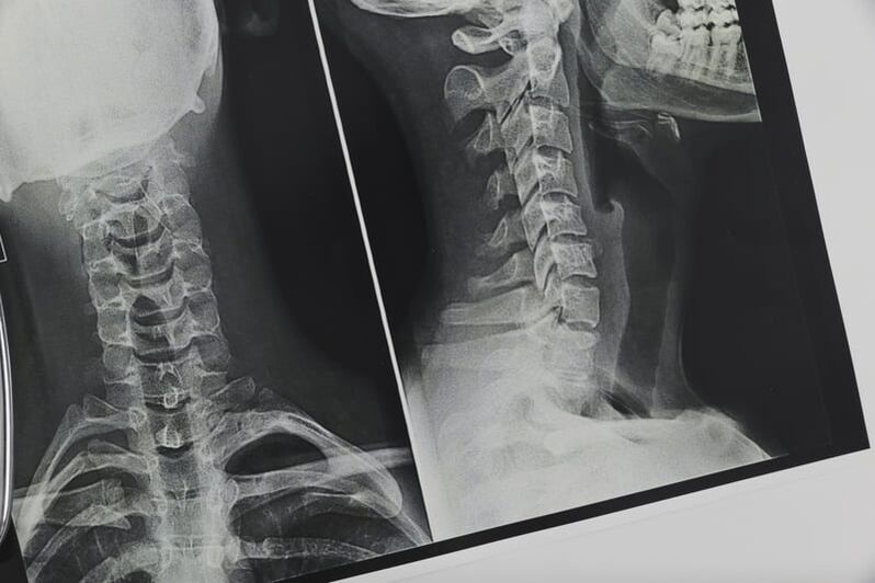 Röntgenfoto van de cervicale wervelkolom aangetast door osteochondrose