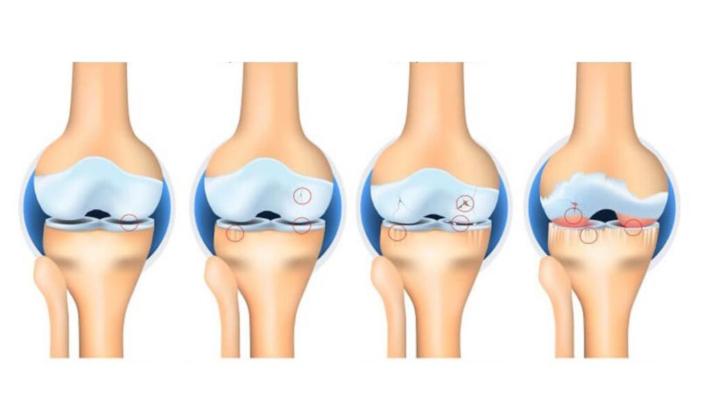 stadia van artrose van het kniegewricht