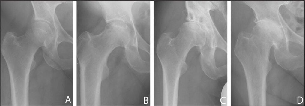 Stadia van ontwikkeling van artrose van het heupgewricht op een röntgenfoto