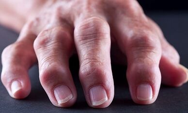 Wat is het verschil tussen artritis van artrose