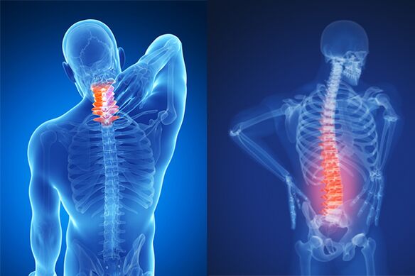 Osteochondrose van de cervicale en lumbale wervelkolom