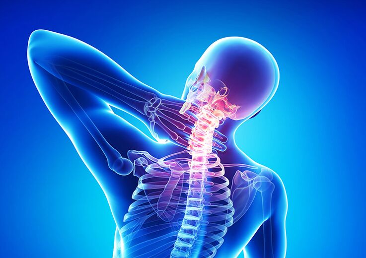 Spinale osteochondrose is een ziekte die het gewrichtskraakbeen en de wervels aantast.