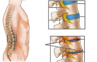 De oorzaken van osteochondrose van de lumbale