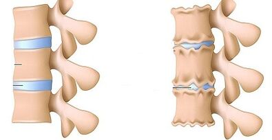 Hoe de aanwezigheid van osteochondrose van de lumbale te herkennen
