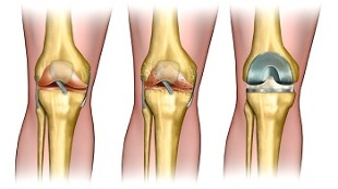 endoprothetica voor artrose van het kniegewricht